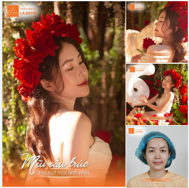 Diện mạo của khách hàng Mỹ Sương đã thật sự thay đổi nhờ phương pháp nâng mũi Mega S.