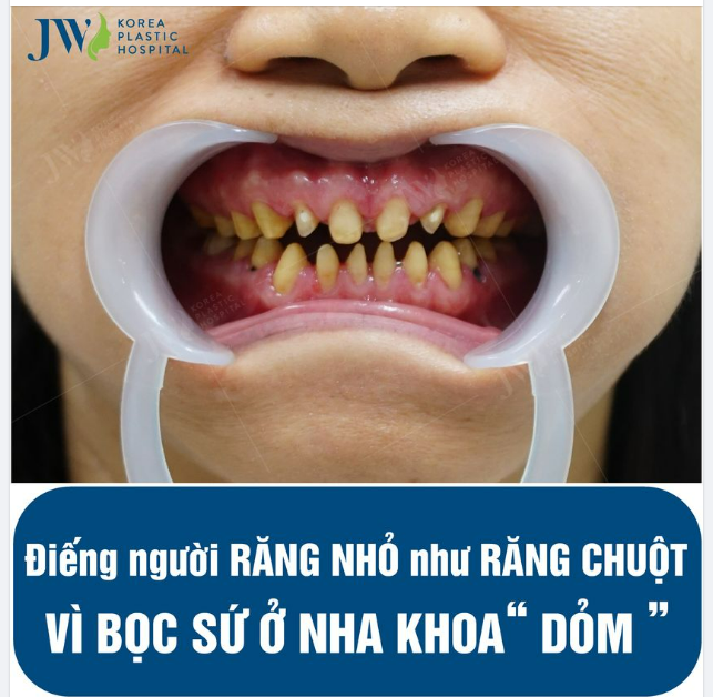 ĐIẾNG NGƯỜI RĂNG NHỎ NHƯ RĂNG CHUỘT VÌ BỌC SỨ Ở NHA KHOA ''DỎM