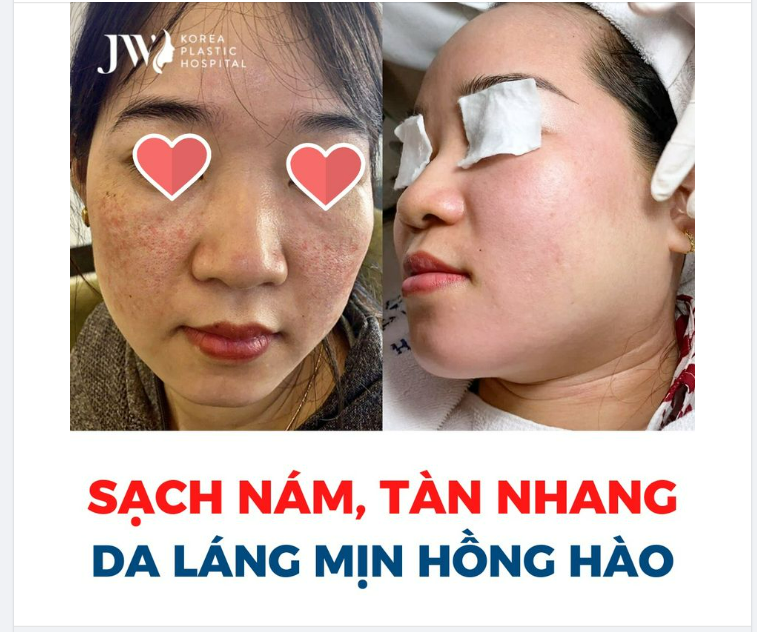 ĐIỀU TRỊ NÁM, TÀN NHANG – DA HỒNG HÀO, TRẮNG SÁNG