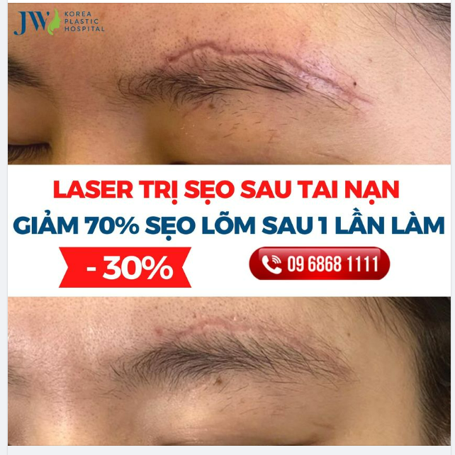 ĐIỀU TRỊ SẸO SAU TAI NẠN TẠI JW, GIẢM 70% SẸO LÕM SAU 1 LẦN LÀM