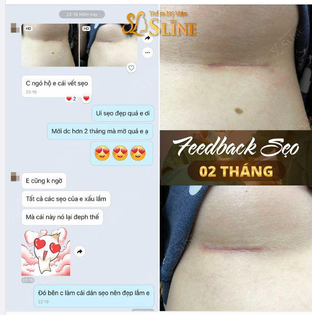 Đố các bạn Vì sao tất cả các Sẹo của bạn ấy xấu, mà sẹo sau nâng cấp vòng 1 với ekip Sline lại đẹp như vậy