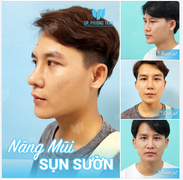 “ĐỔI GIÓ” VỚI MŨI SỤN SƯỜN NAM GIỚI CẢ NHÀ NHỈ