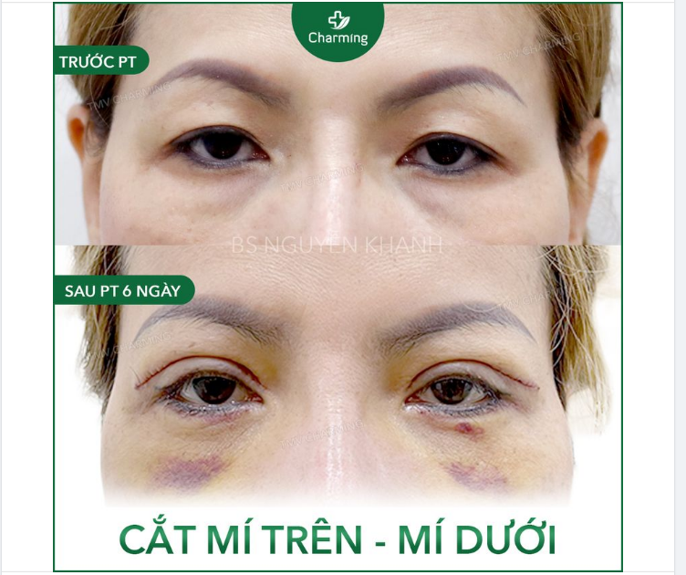 Đôi mắt phẫu thuật cắt mí trên lẫn dưới sau 6 ngày vẫn sưng, bầm là chuyện bình thường.