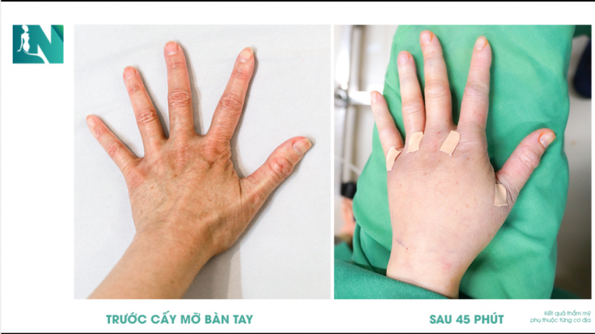 ĐÔI TAY THON NUỘT TUỔI ĐÔI MƯƠI