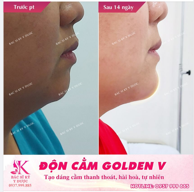 Độn cằm Golden - V là phẫu thuật thẩm mỹ khắc phục tình trạng cằm ngắn, cằm lẹm, đem lại dáng cằm thon gọn cân bằng.