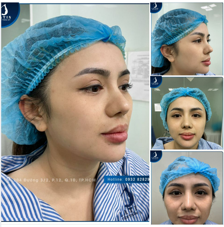 Độn cằm nội soi - không phẫu thuật, không đau đớn, không để lại sẹo 