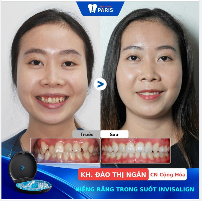 Đơn giản là nụ cười đều đẹp nhờ Invisalign