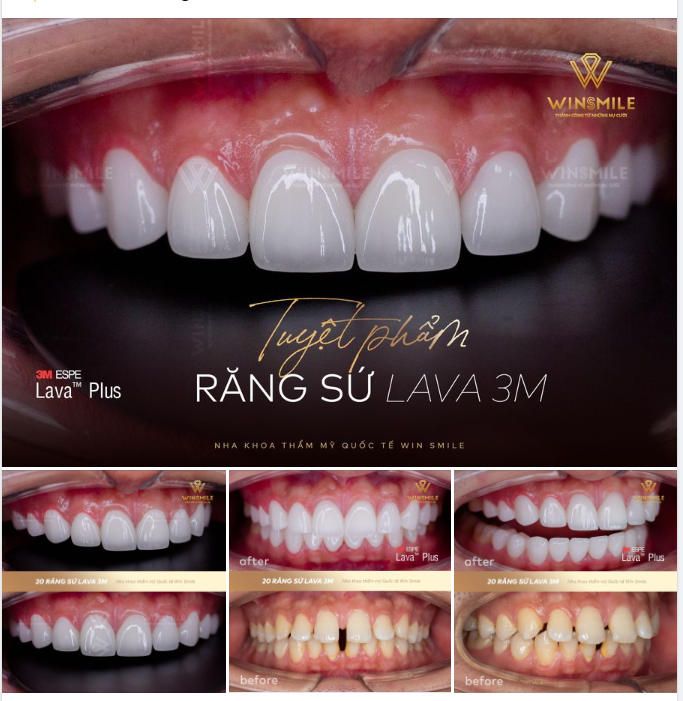 “ĐÓNG CỬA” RĂNG THƯA - MỞ CỬA THÀNH CÔNG