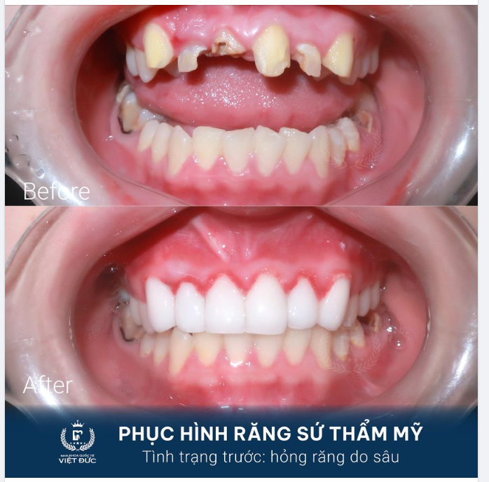 ĐỪNG COI NHẸ SÂU RĂNG BẠN NHÉ!