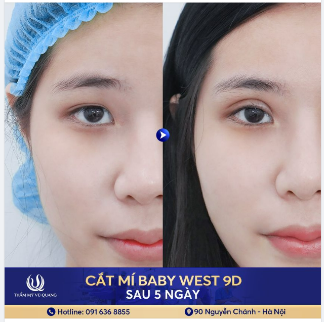 Đừng để đôi mắt sụp mí giết chết nét rạng ngời trên gương mặt bạn.