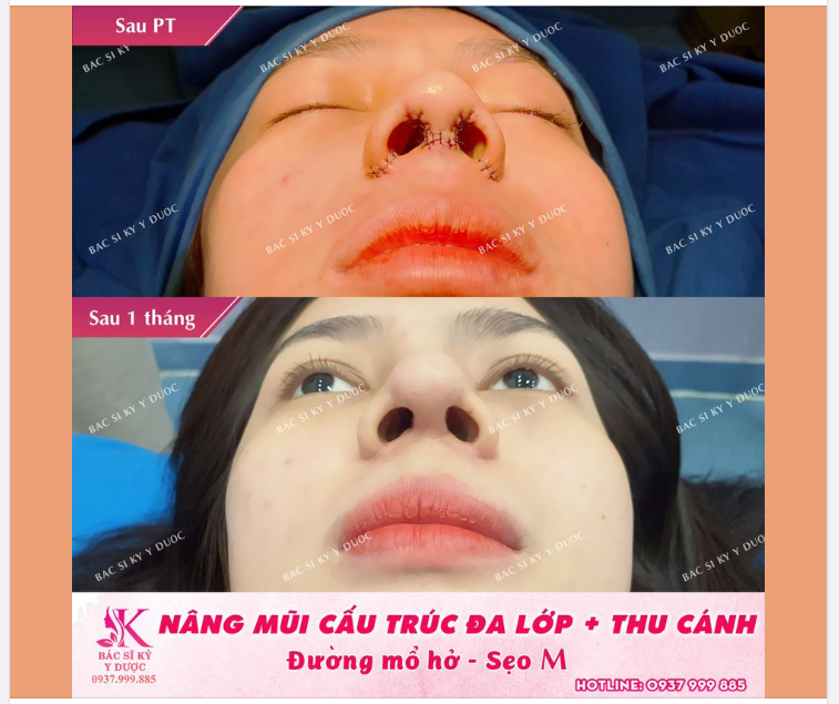 Đường may nâng mũi cấu trúc sẽ như thế nào