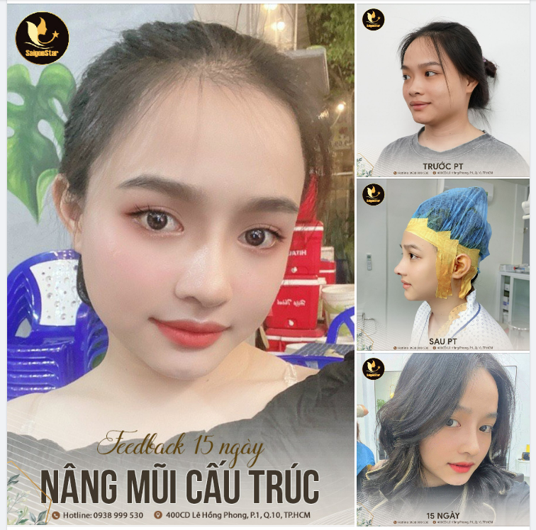 FEEDBACK 15 NGÀY NÂNG MŨI CẤU TRÚC