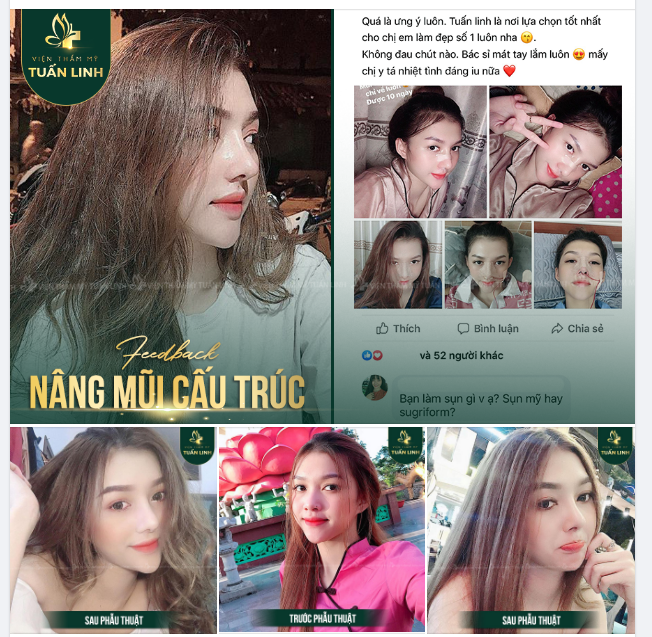 FEEDBACK CỦA KHÁCH HÀNG T.H SAU NÂNG MŨI CẤU TRÚC TẠI TUẤN LINH.