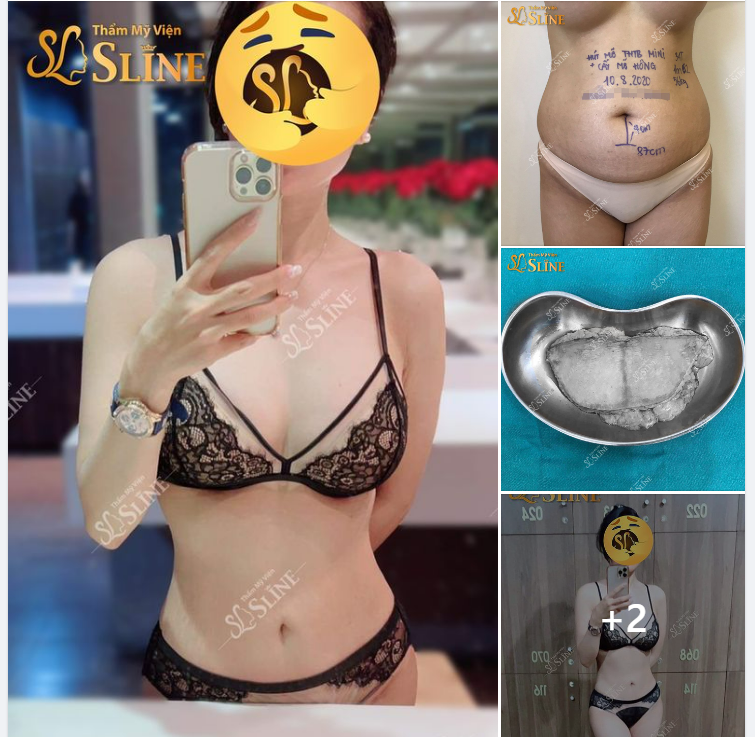 Feedback khách hàng thực hiện combo Hút mỡ tạo hình. Cấy mỡ hông.