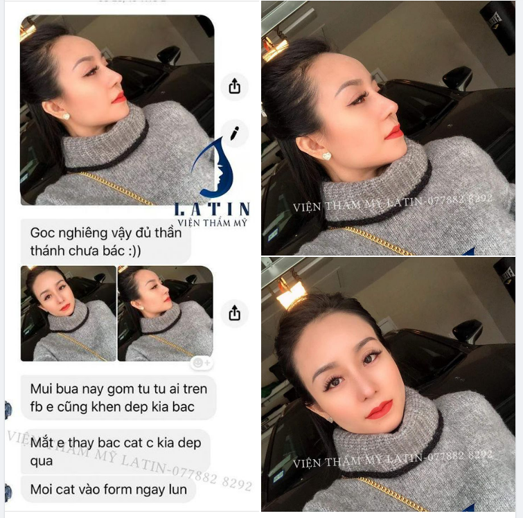 Feedback mũi cấu trúc sửa lại + cắt mí 4D sau 1 tháng tại Latin