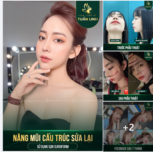 FEEDBACK Nâng mũi cấu trúc sửa lại sụn Surgiform