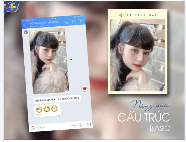 Feedback sau 1 tháng nâng mũi cấu trúc basic