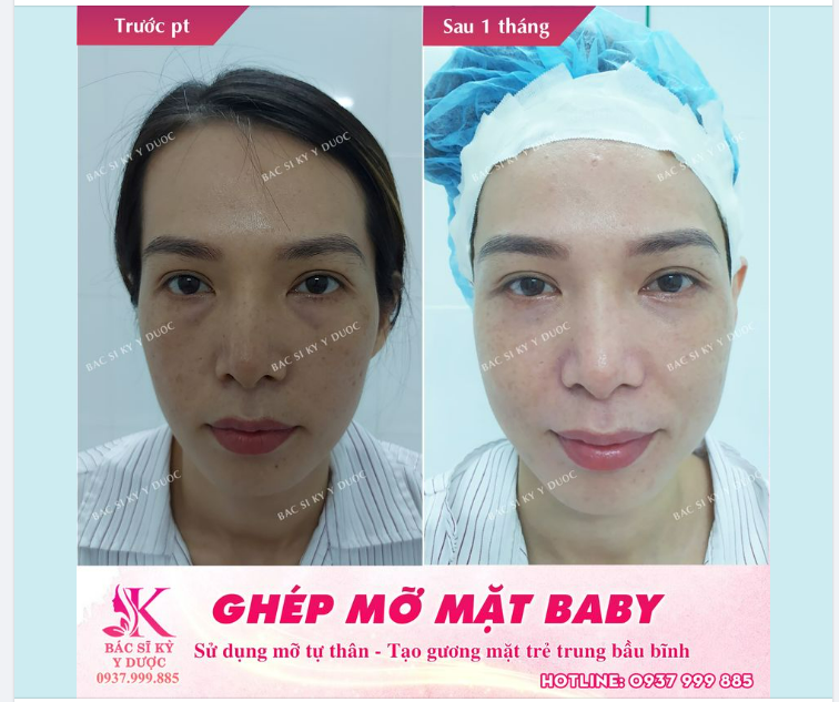 GHÉP MỠ MẶT BABY - MÁ ĐÀO TÀI LỘC