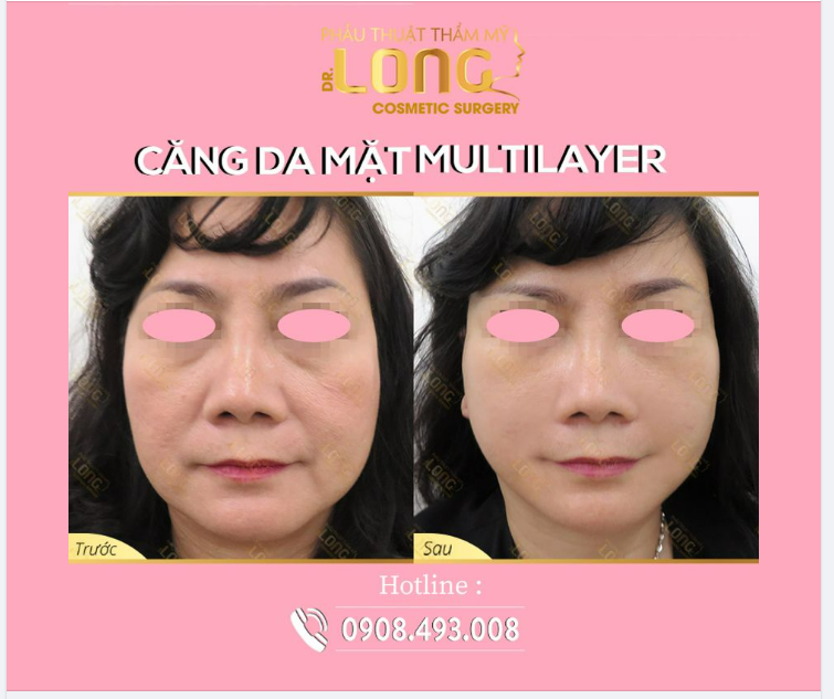 Già đi…ai mà chẳng sợ…nhất là phụ nữ. Lão hóa ập đến khiến bạn lo lắng, nếp nhăn xuất hiện khiến bạn bất an, can thiệp ngay khi chưa quá muộn.