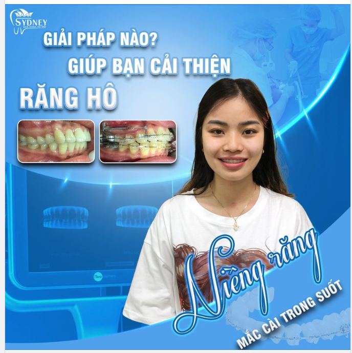 GIẢI PHẤP CẢI THIỆN RĂNG HÔ