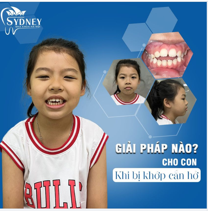 Giải pháp nào cho con khi bị khớp cắn hở?