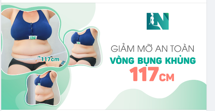 GIẢM MỠ AN TOÀN CHO VÒNG BỤNG KHỦNG 117CM