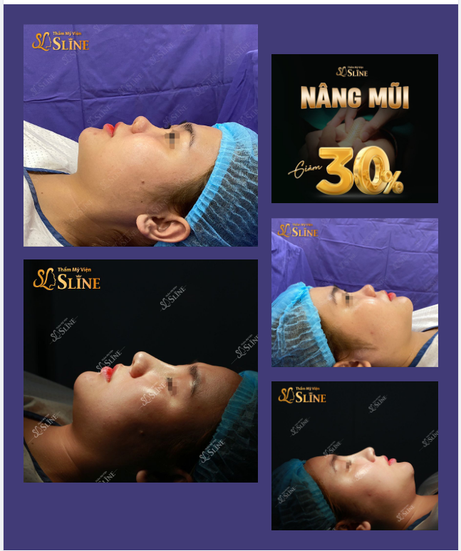 GIẢM NGAY 30% cho dịch vụ nâng mũi.