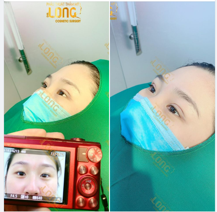Giới thiệu đến bạn phương pháp cắt mí Plasma