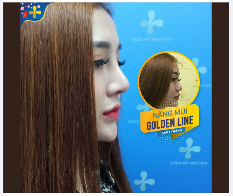 Góc nghiêng đẹp miễn chê sau khi nâng mũi Golden Line - Dr.Tống Hải.