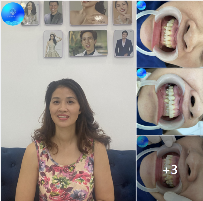  Hành trình thẩm mỹ răng sứ của chị Hoài