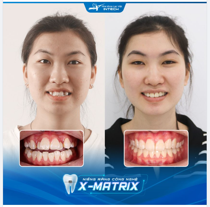 HẾT CHEN CHÚC NHỜ NIỀNG RĂNG CÔNG NGHỆ X-MATRIX