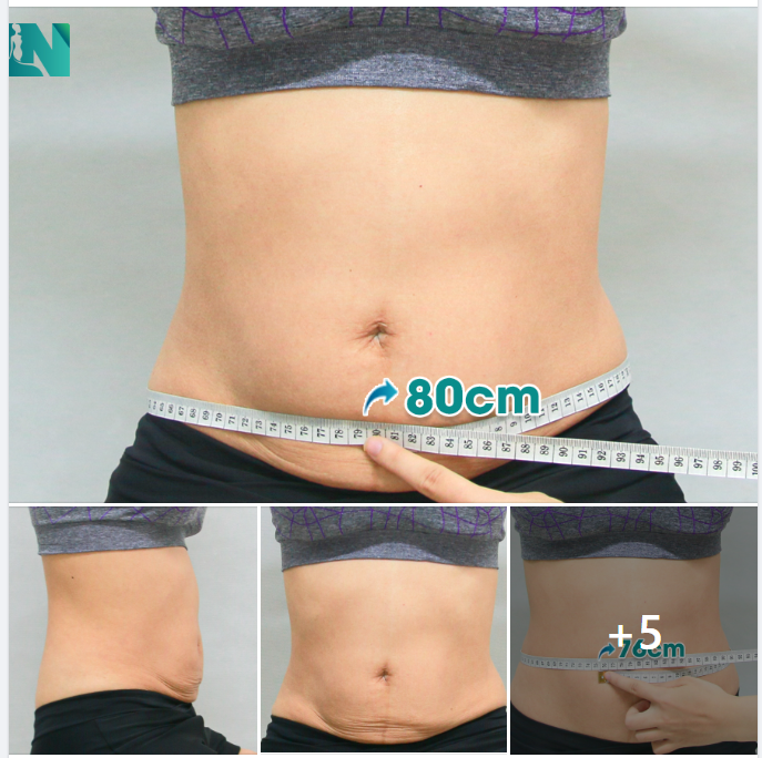 HIỆN THỰC MONG ƯỚC VÒNG EO CON KIẾN CHO CHỊ KH (39 TUỔI)