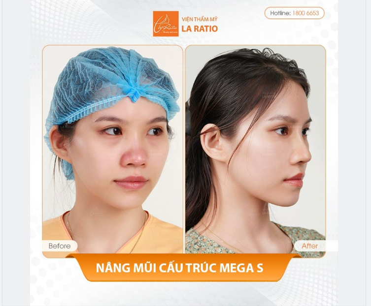 HIỂU VỀ BỌC SỤN MEGADERM