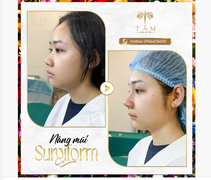 Hình ảnh so sánh trước và ngay sau nâng mũi Surgiform cho khách hàng TMV Tấm.