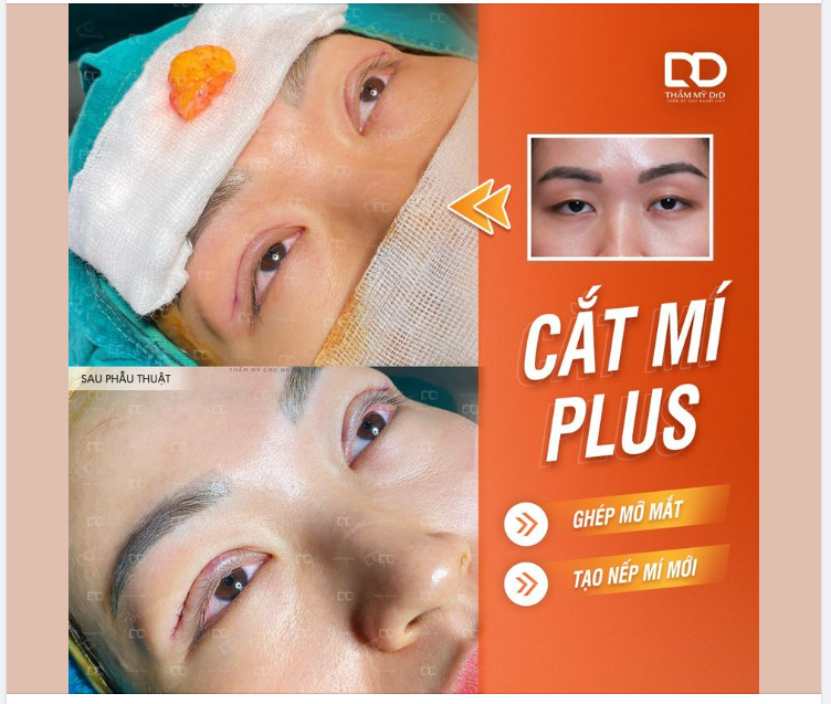 Hình ảnh tổ chức mỡ được lấy từ vùng rốn của chính khách hàng để ghép vào vùng mắt bị trũng sâu.