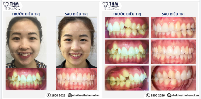 HOÀN TẤT CHỈNH NHA INVISALIGN