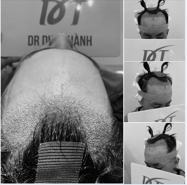 HOÀN THÀNH TÁC PHẨM CẤY TÓC 1200 NANG CHO BOY HÀ TĨNH