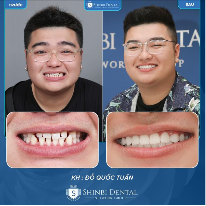 HOÀN THIỆN NỤ CƯỜI - TỰ TIN RẠNG NGỜI