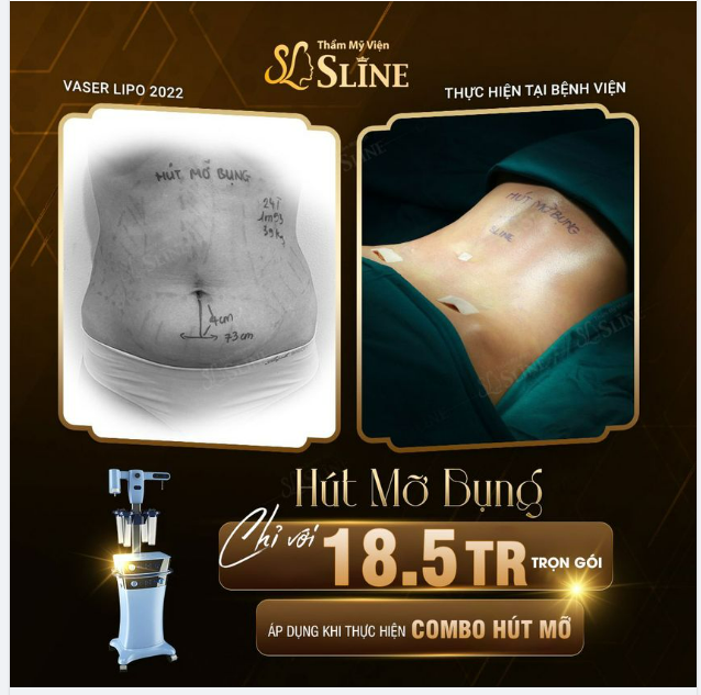 HOT HOT Hút mỡ bụng