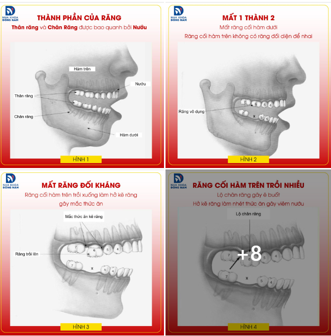 Hư 1 răng Không điều trị Nhổ răng Xô lệch răng bên cạnh, trồi răng đối diện, tiêu xương hàm Không điều trị ​​​​​​​ Mất thêm nhiều răng