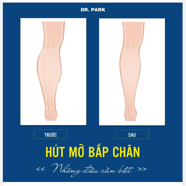 HÚT MỠ BẮP CHÂN NHỮNG ĐIỀU BẠN CẦN BIẾT!
