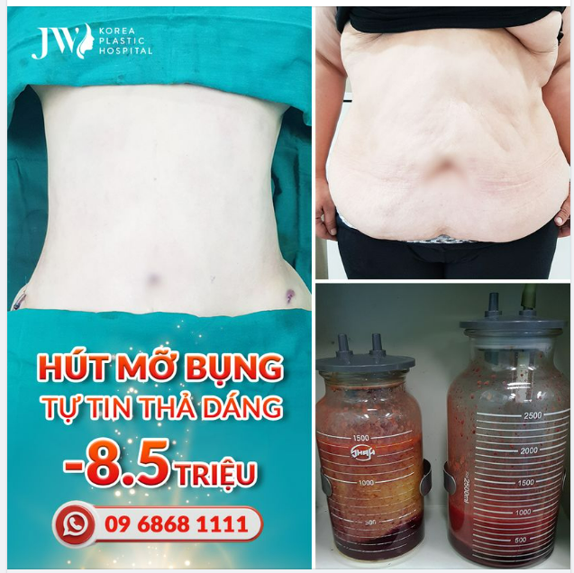 HÚT MỠ BỤNG LASER LIPO - TỰ TIN THẢ DÁNG