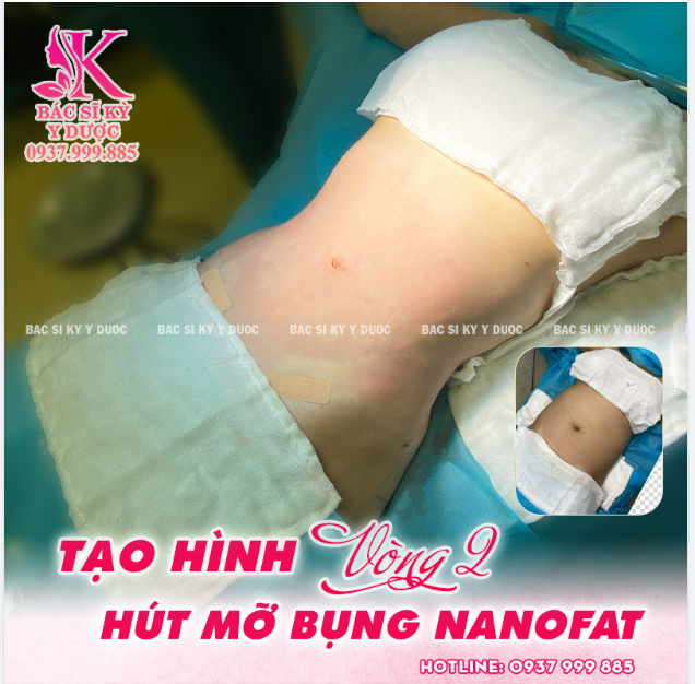 Hút mỡ bụng toàn phần kết hợp tạo hình thành bụng tại Bác Sĩ Kỳ Y Dược