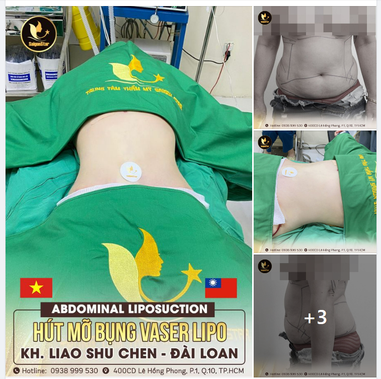 HÚT MỠ BỤNG VASER LIPO