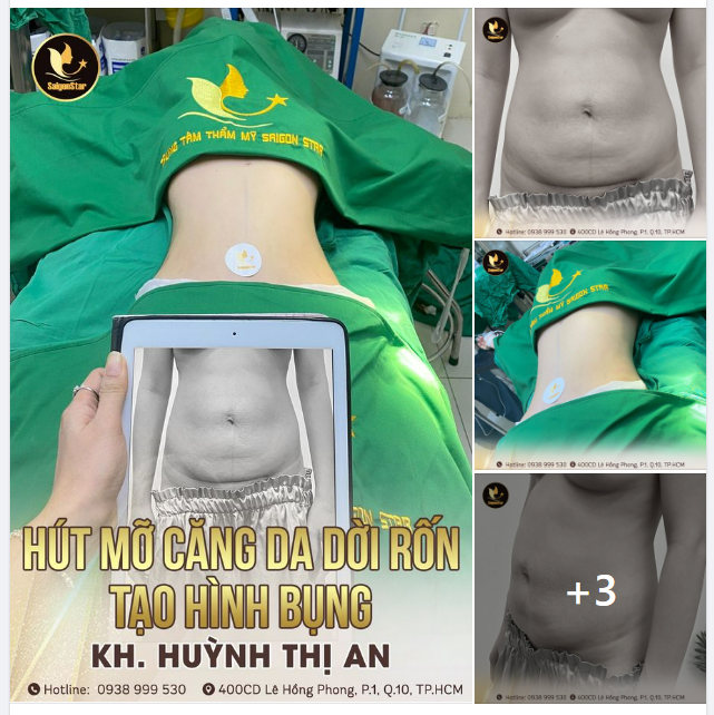 HÚT MỠ CĂNG DA DỜI RỐN TẠO HÌNH BỤNG