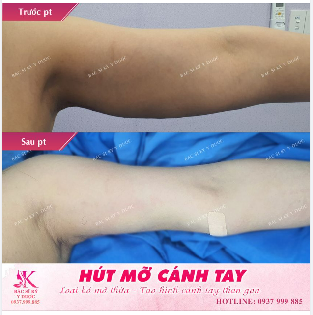 HÚT MỠ CÁNH TAY chưa bao giờ hết HOT