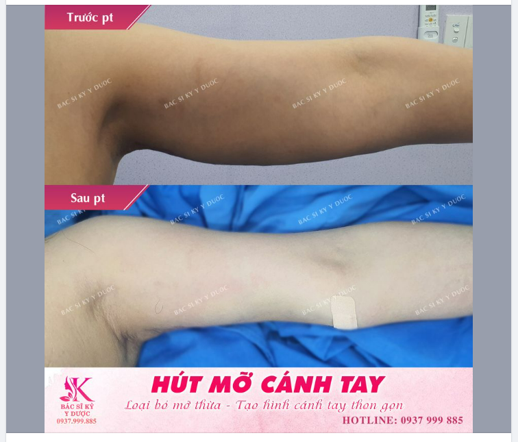 HÚT MỠ CÁNH TAY - GIẢI PHÁP CHO CÁCH TAY NHIỀU MỠ THỪA VÀ DA TRÙNG
