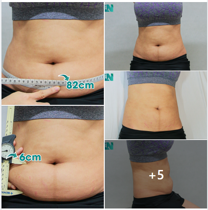 HÚT MỠ TẠO DÁNG THẨM MỸ CHO CHỊ KH 36 TUỔI ĐẾN TỪ KIÊN GIANG VỚI CÁC VÙNG BỤNG, TAY, LƯNG, NÁCH. 