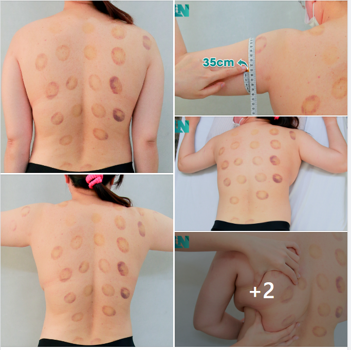  HÚT MỠ TẠO DÁNG THẨM MỸ VÙNG TAY, LƯNG, NÁCH – CÂN CHỈNH DÁNG VÓC CHO CHỊ KH 39 TUỔI. 