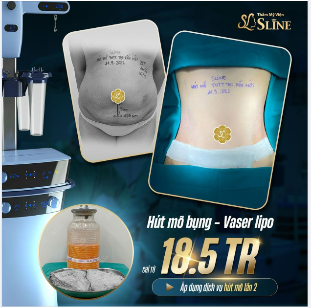 HÚT MỠ TRỌN GÓI